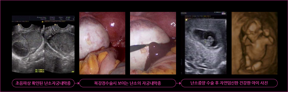 -초음파상 확인된 난소자궁내막증 -복강경수술시 보이는 난소의 자궁내막증 -난소종양 수술 후 자연임신된 건강한 아이 사진